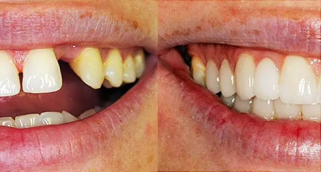 Imagem com antes e depois de tratamento odontológico. A primeira mostra dentes quebrados, a segunda mostra os dentes perfeitos após o procedimento.
